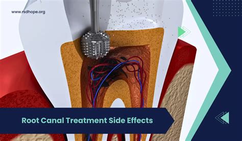 root canal treatment side effects